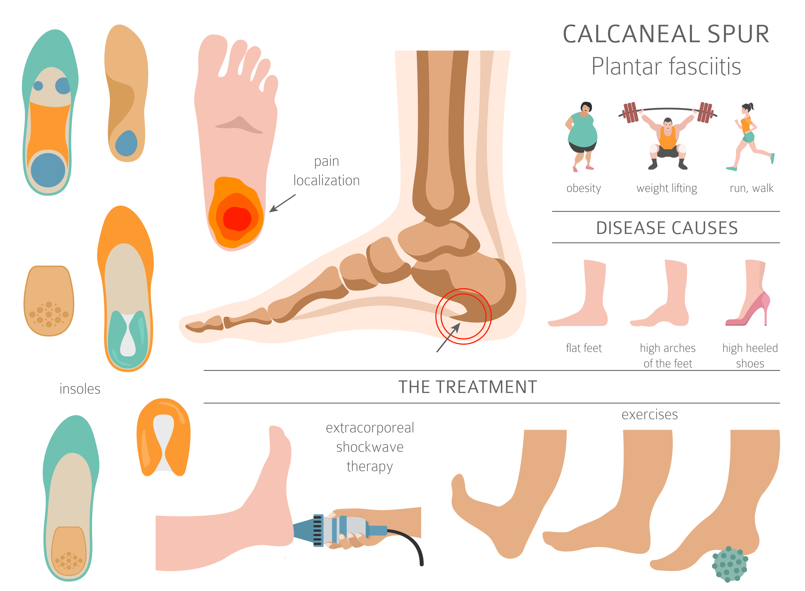 Plantar Fasciitis Causes - Treatment @ MDIMC