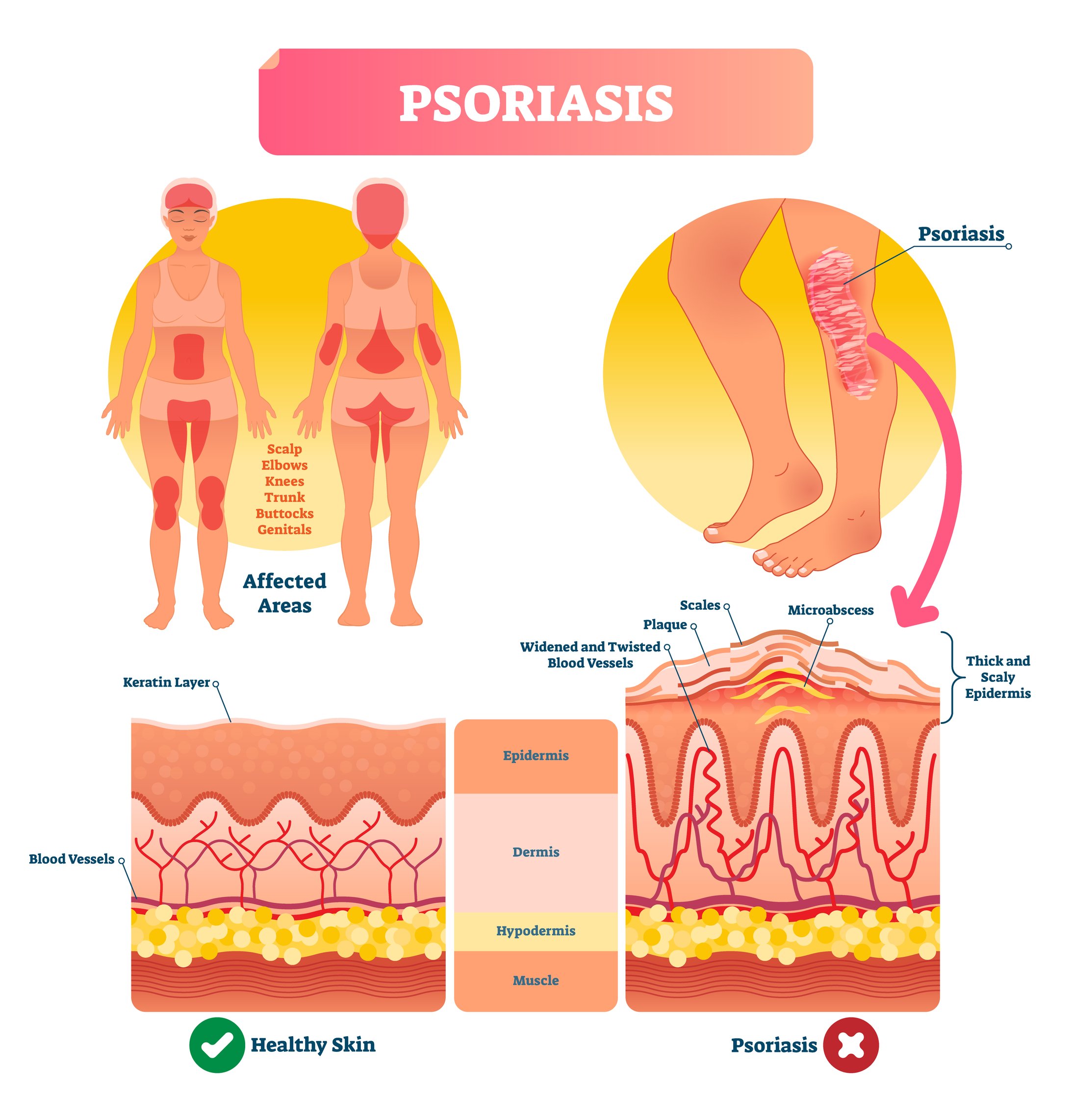 Psoriasis - Treatment @ MDIMC