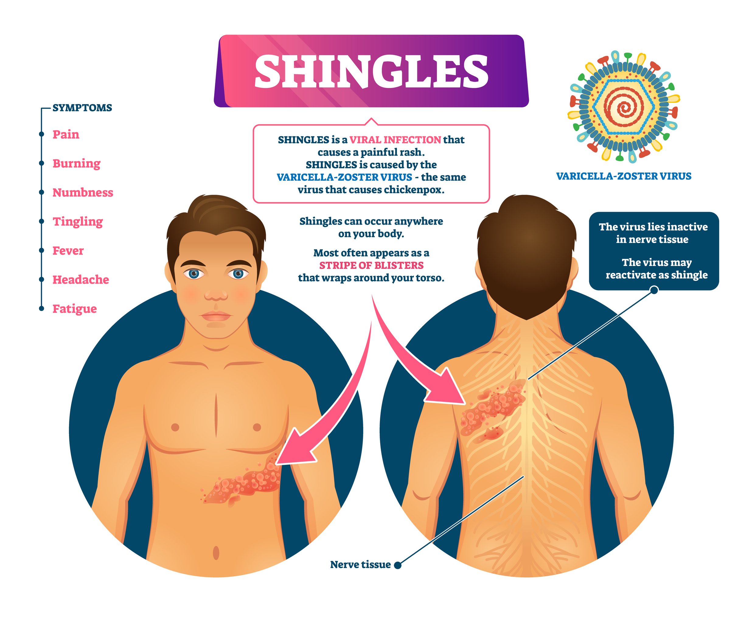 Shingles Causes & Symptoms - Treatment @ MDIMC