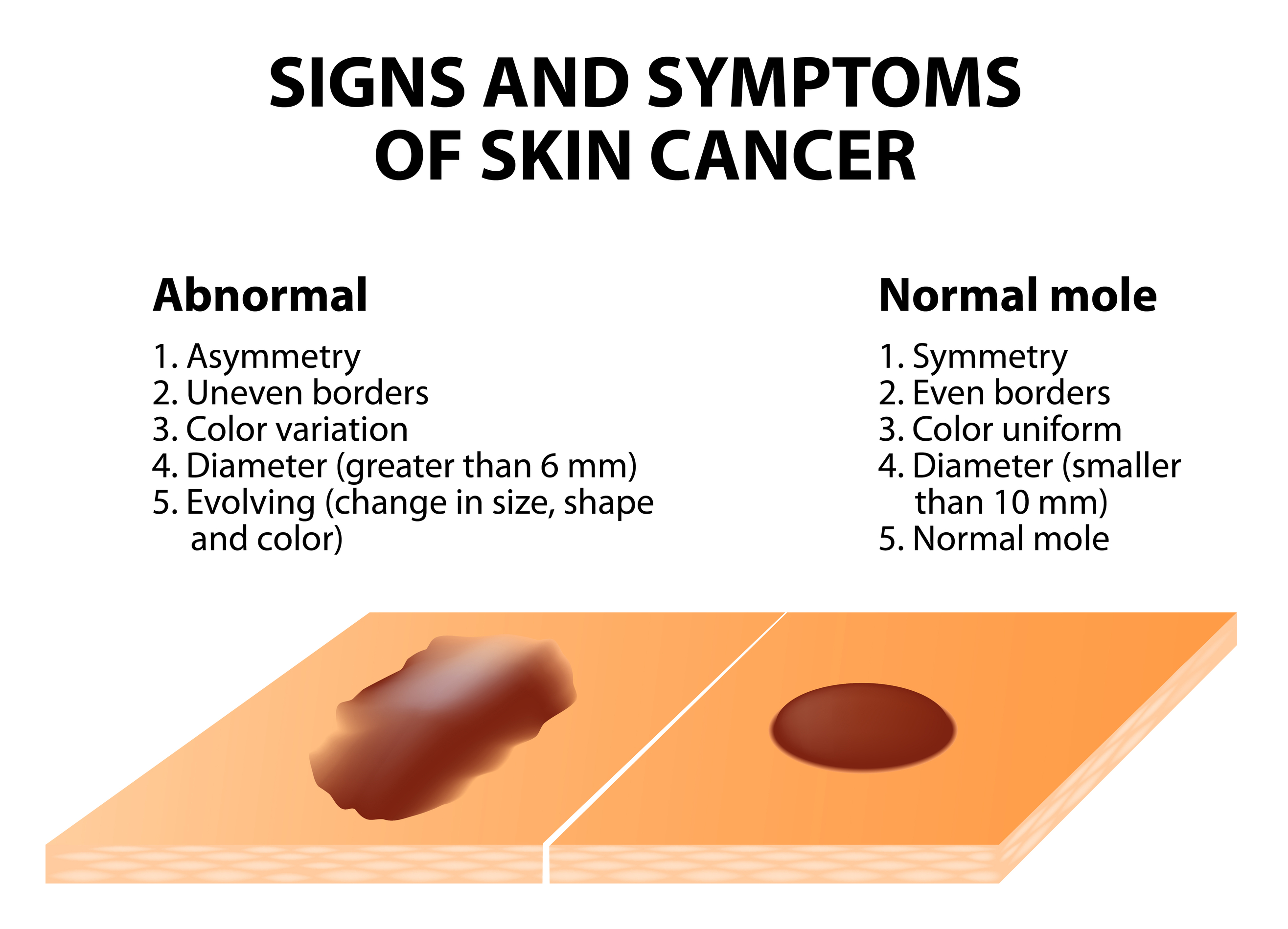 Skin Cancer Signs & Symptoms - MDIMC