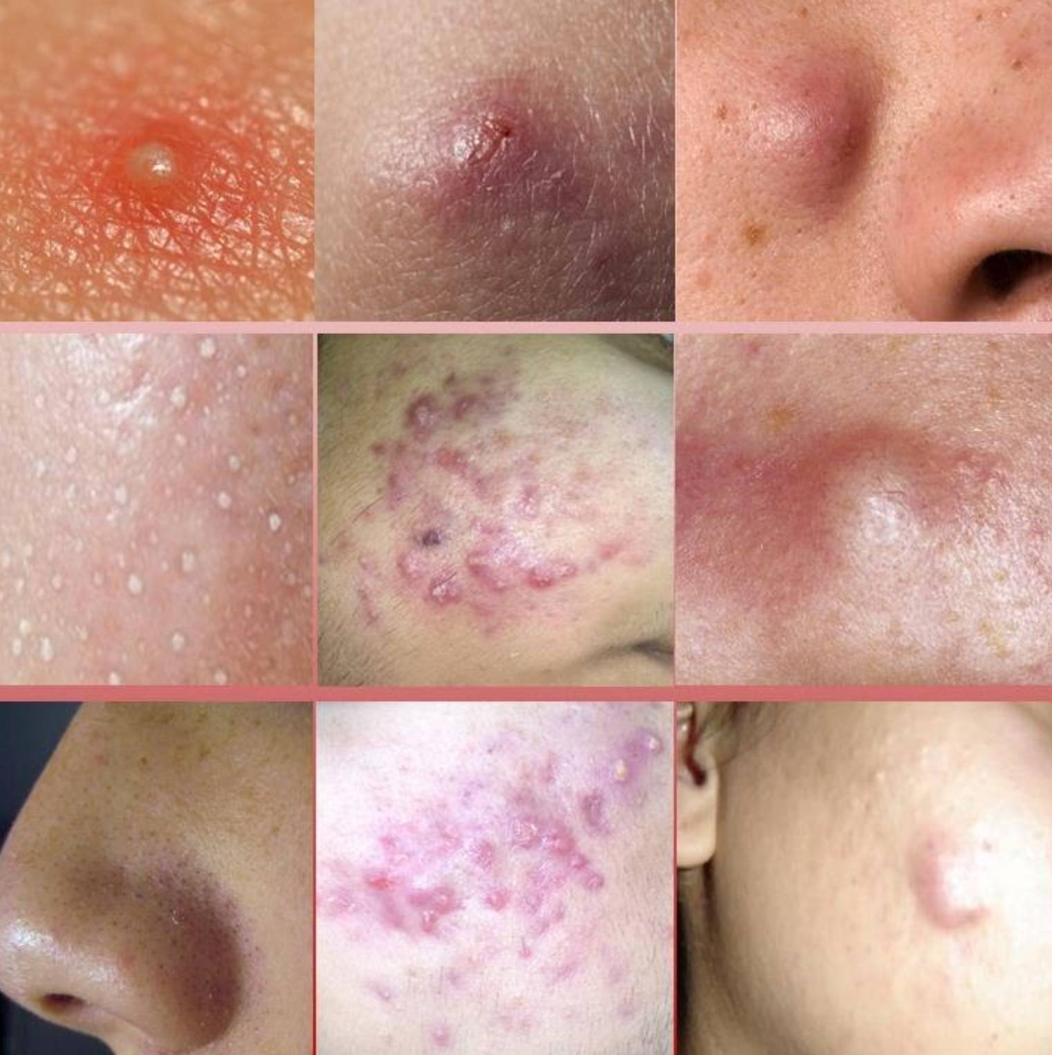 How to Get Rid of Acne How to Get Rid of Acne