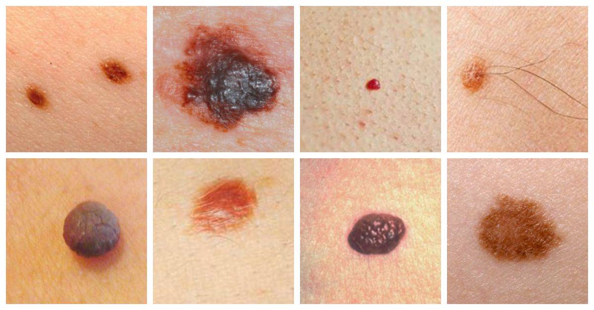 skin moles to worry about